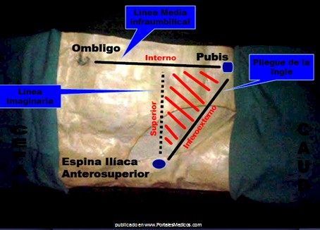 hernias_inguinales/regiones_zona_inguinal