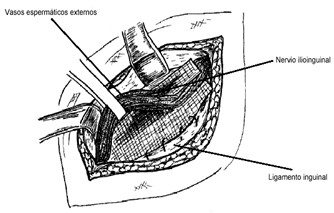 hernias_inguinales/tecnica_de_lichtenstein