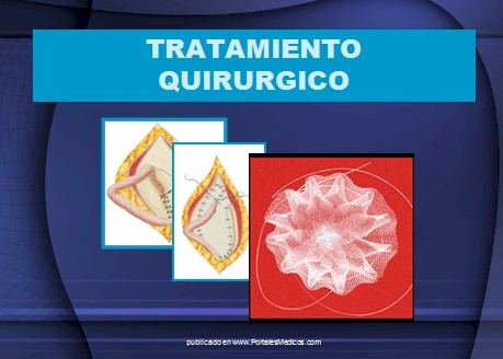 hernias_inguinales/tratamiento_quirurgico