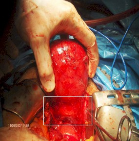 leiomiomatosis_recidivada_posthisterectomia/mioma_uterino_cirugia