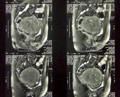 leiomiomatosis_recidivada_posthisterectomia/resonancia_magnetica_nuclear_RMN