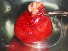 leiomiomatosis_recidivada_posthisterectomia/utero_miomatoso