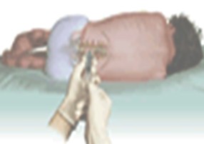 meningitis_bacteriana/puncion_lumbar meningitis_bacteriana/puncion_lumbar