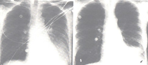 patologia_pleural/derrame_cisural_pleura patologia_pleural/derrame_cisural_pleura