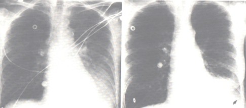 patologia_pleural/derrame_cisural_pleura