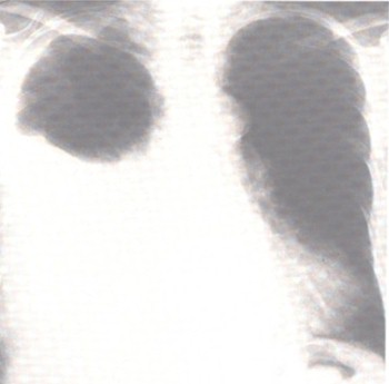 patologia_pleural/derrame_pleural_atelectasia patologia_pleural/derrame_pleural_atelectasia
