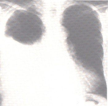 patologia_pleural/derrame_pleural_atelectasia