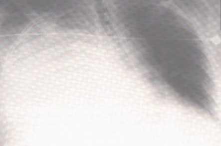 patologia_pleural/derrame_pleural_masivo patologia_pleural/derrame_pleural_masivo