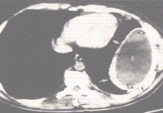 patologia_pleural/empiema_TAC patologia_pleural/empiema_TAC