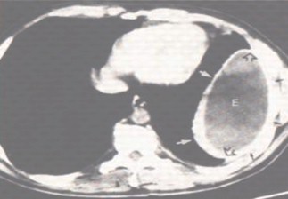 patologia_pleural/empiema_TAC