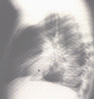 patologia_pleural/empiema_radiografia_lateral