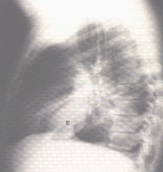 patologia_pleural/empiema_radiografia_lateral patologia_pleural/empiema_radiografia_lateral