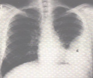 patologia_pleural/empiema_radiografia_torax patologia_pleural/empiema_radiografia_torax