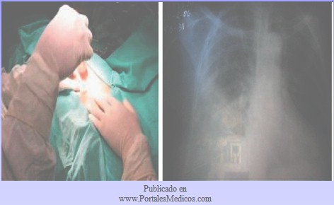 patologia_pleural/puncion_derrame_pleurocentesis