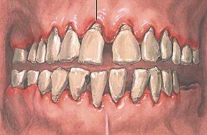 patologia_sistema_estomatognatico/gingivitis