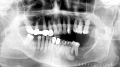 patologia_sistema_estomatognatico/hiperplasia_condilar