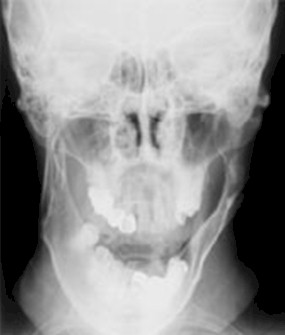 patologia_sistema_estomatognatico/hiperplasia_condilo