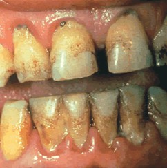 patologia_sistema_estomatognatico/periodontitis