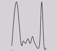 proteinas_plasmaticas_hemopatias/gammapatia_monoclonal