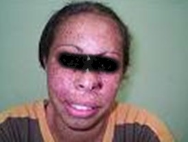 xeroderma_pigmentoso_Kaposi/carcinoma_basoescamoso