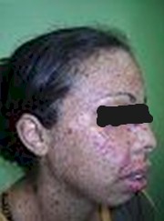 xeroderma_pigmentoso_Kaposi/carcinoma_metatipico