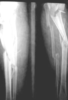 evaluacion_anatomofuncional_tibia/fractura_conminutiva_minuta