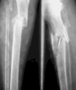 evaluacion_anatomofuncional_tibia/fractura_defecto_oseo