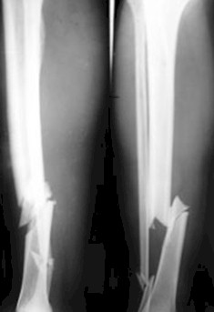 evaluacion_anatomofuncional_tibia/fractura_fragmento_libre