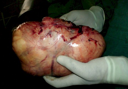 ovarian_fibroid_pregnancy/anexectomy_operation