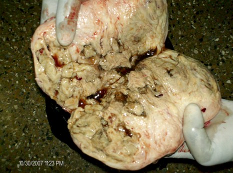 ovarian_fibroid_pregnancy/ovarian_dissection