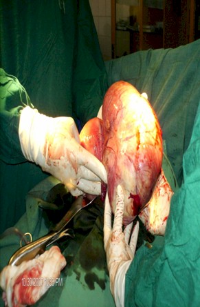 ovarian_fibroid_pregnancy/ovaric_tumor_tumour