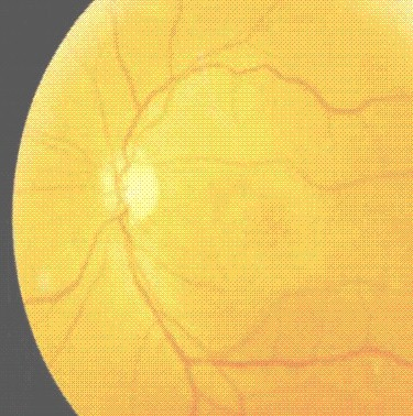 toxicidad_ocular_tamoxifeno/alteraciones_retinianas