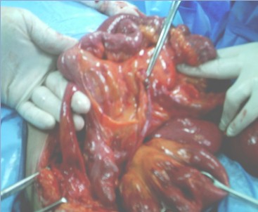 volvulo_diverticulo_meckel/obstruccion_intestinal_apendice