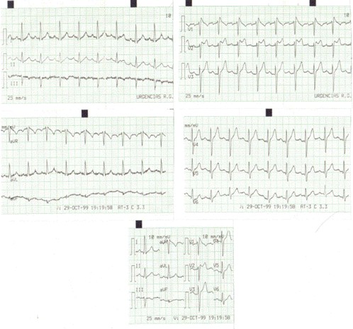 caso_clinico_ECG/sindrome_brugada caso_clinico_ECG/sindrome_brugada