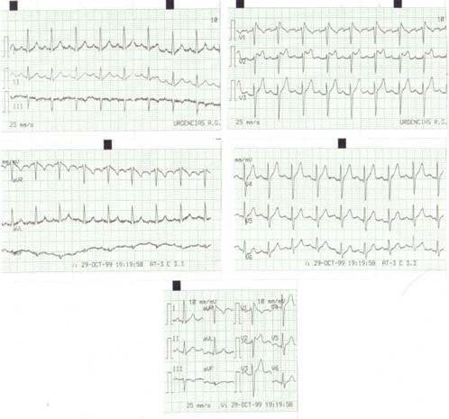 caso_clinico_ECG/sindrome_brugada