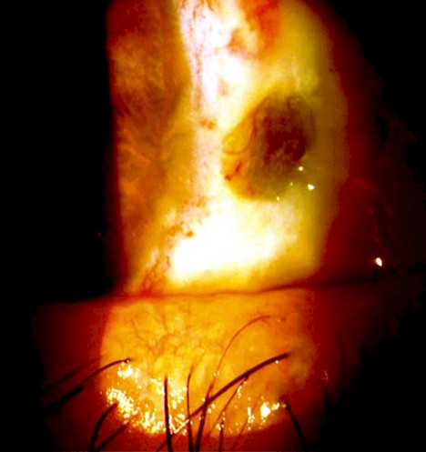escleritis_anterior_necrotizante/episcleritis_epiescleritis escleritis_anterior_necrotizante/episcleritis_epiescleritis