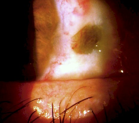 escleritis_anterior_necrotizante/esclera_episclera_pterigium