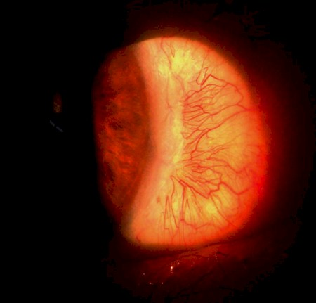 escleritis_anterior_necrotizante/localizacion_exeresis_pterigium escleritis_anterior_necrotizante/localizacion_exeresis_pterigium