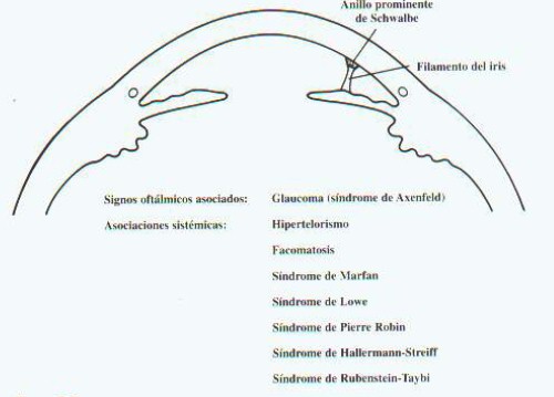 malformaciones_congenitas_cornea/anillo_linea_Schwalbe malformaciones_congenitas_cornea/anillo_linea_Schwalbe