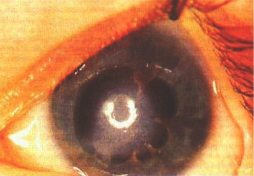 malformaciones_congenitas_cornea/anomalia_Peters