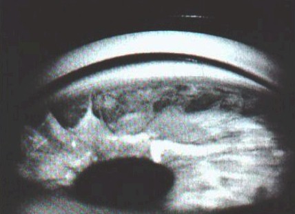 malformaciones_congenitas_cornea/anomalia_sindrome_Axenfeld