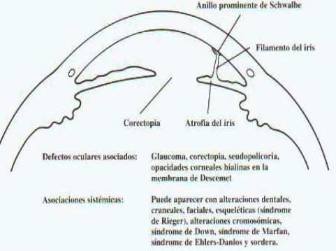 malformaciones_congenitas_cornea/anomalia_sindrome_Rieger