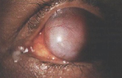 malformaciones_congenitas_cornea/estafiloma_anterior_congenito