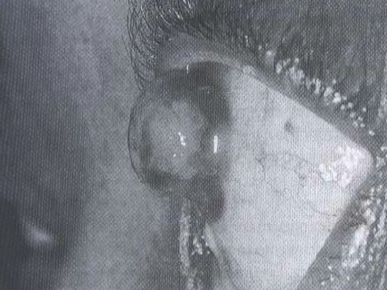 malformaciones_congenitas_cornea/estafiloma_tejido_uveal malformaciones_congenitas_cornea/estafiloma_tejido_uveal