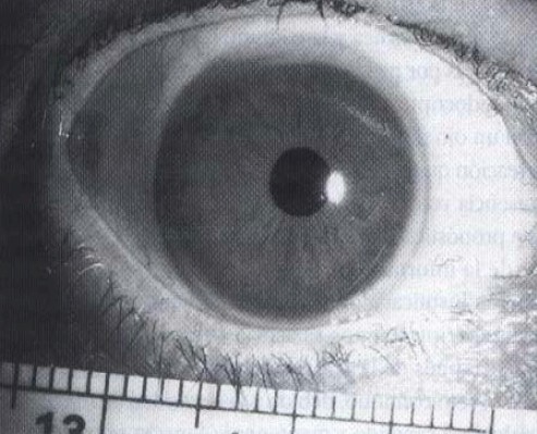 malformaciones_congenitas_cornea/megalocornea malformaciones_congenitas_cornea/megalocornea
