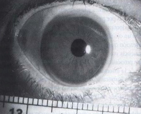 malformaciones_congenitas_cornea/megalocornea