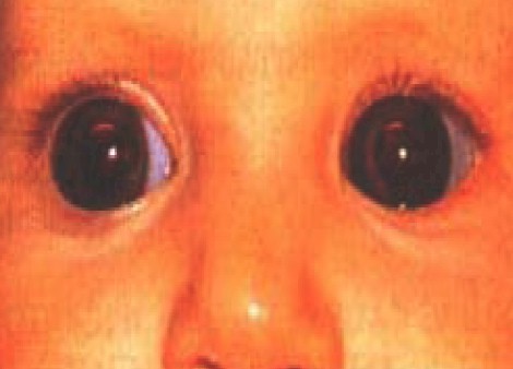 malformaciones_congenitas_cornea/megalocornea_corneal malformaciones_congenitas_cornea/megalocornea_corneal