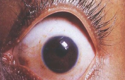 malformaciones_congenitas_cornea/microcornea malformaciones_congenitas_cornea/microcornea