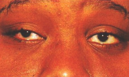 malformaciones_congenitas_cornea/microcornea_bilateral malformaciones_congenitas_cornea/microcornea_bilateral