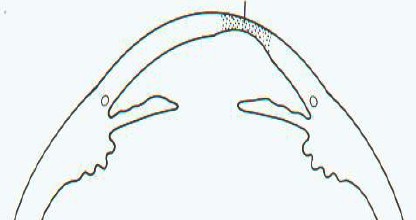 malformaciones_congenitas_cornea/queratocono_posterior